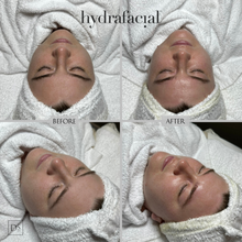 Load image into Gallery viewer, Day 5: Hydrafacial Platinum Plus - Buy 3 Get 1 Free