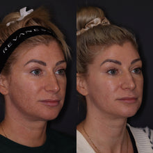 Load image into Gallery viewer, Laser Resurfacing Face - Buy 3 Get 1 Free