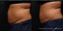 Load image into Gallery viewer, Day 3: Coolsculpting Elite Membership Deposit