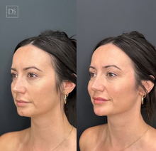 Load image into Gallery viewer, Day 8: Facial Harmonization (6 HA + 40 Units Neuromodulators)