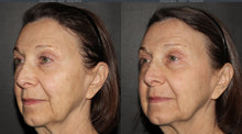 Load image into Gallery viewer, Laser Resurfacing Face - Buy 3 Get 1 Free