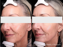Load image into Gallery viewer, Laser Resurfacing Face - Buy 3 Get 1 Free