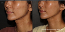 Load image into Gallery viewer, Day 7: Microneedling with Radiofrequency with Exosomes for Face - Buy 3 Get 1 Free