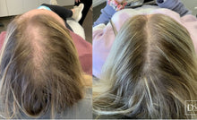 Load image into Gallery viewer, Hair Restoration: Microneedling with Exosomes, Buy 3 Get 1 Free
