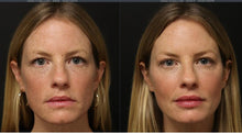Load image into Gallery viewer, Dermal Filler - Buy 3 Get 1 Free