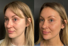 Load image into Gallery viewer, Dermal Filler - Buy 3 Get 1 Free