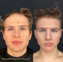 Load image into Gallery viewer, Alumier Peels for Face - Buy 3 Get 1 Free
