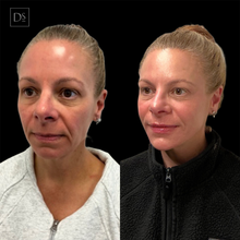 Load image into Gallery viewer, Day 4: Dermal Filler - Buy 3 Get 1 Free
