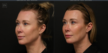 Load image into Gallery viewer, Day 4: Dermal Filler - Buy 3 Get 1 Free

