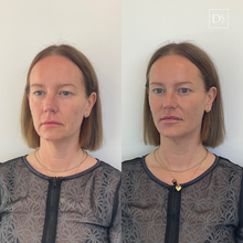 Load image into Gallery viewer, Day 8: Facial Harmonization (6 HA + 40 Units Neuromodulators)
