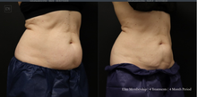 Load image into Gallery viewer, Day 3: Coolsculpting Elite Membership Deposit
