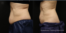 Load image into Gallery viewer, Day 3: Coolsculpting Elite Membership Deposit
