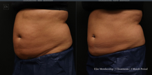 Load image into Gallery viewer, Day 3: Coolsculpting Elite Membership Deposit

