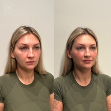 Load image into Gallery viewer, Day 8: Facial Harmonization (6 HA + 40 Units Neuromodulators)
