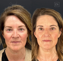 Load image into Gallery viewer, Day 8: Facial Harmonization (6 HA + 40 Units Neuromodulators)
