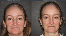 Load image into Gallery viewer, Day 2: IPL/Laser Genesis/Excel V+ for Face, Neck &amp; Décolleté - Buy 3 Get 1 Free
