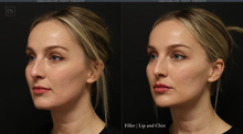 Load image into Gallery viewer, Day 10: Lip &amp; Chin Balancing
