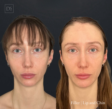Load image into Gallery viewer, Day 10: Lip &amp; Chin Balancing
