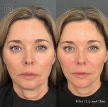 Load image into Gallery viewer, Day 10: Lip &amp; Chin Balancing
