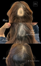 Load image into Gallery viewer, Day 6: Platelet Rich Plasma (PRP)/Platelet-Rich Fibrin (PRF) - Buy 3 Get 1 Free
