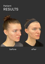 Load image into Gallery viewer, April Focus: Microneedling with Exosomes &amp; Chemical Peels for the Face
