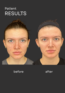 April Focus: Microneedling with Exosomes & Chemical Peels for the Face