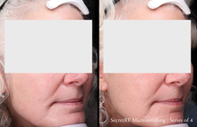 Load image into Gallery viewer, Day 7: Microneedling with Radiofrequency with Exosomes for Face - Buy 3 Get 1 Free
