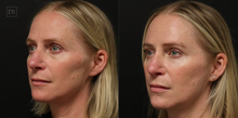 Load image into Gallery viewer, Day 7: Microneedling with Exosomes for Face &amp; Neck - Buy 3 Get 1 Free
