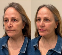 Load image into Gallery viewer, Dermal Filler - Buy 3 Get 1 Free
