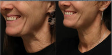 Load image into Gallery viewer, HArmonyCa Biostimulator - 3 Vial Treatment
