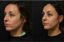 Load image into Gallery viewer, Dermal Filler - Buy 3 Get 1 Free
