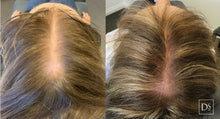 Load image into Gallery viewer, Hair Restoration: Microneedling with Exosomes,  Buy 3 Get 1 Free
