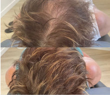 Load image into Gallery viewer, Hair Restoration: Microneedling with Exosomes,  Buy 3 Get 1 Free
