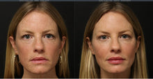 Load image into Gallery viewer, Facial Harmonization (5ml filler+ 1ml Skinvive™+ 20u neurmodulator)
