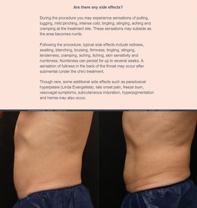 CoolSculpting Spring Refresh - $1,250 cash back on purchases of $4,500 or more.