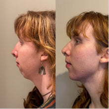 Load image into Gallery viewer, Dermal Filler - Buy 3 Get 1 Free
