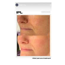 Load image into Gallery viewer, Day 3: Intense Pulsed Light (IPL) (face, neck &amp; décolleté) buy 3 get 1 free
