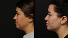 Load image into Gallery viewer, Patient had Belkyra under the chin. Photos are 60 days apart. 

