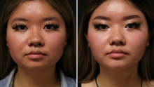 Load image into Gallery viewer, Patient had Belkyra to her cheeks to achieve a slimmer face shape.
