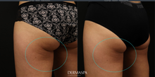 Load image into Gallery viewer, CoolSculpting Treatment

