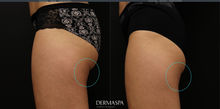 Load image into Gallery viewer, CoolSculpting Treatment
